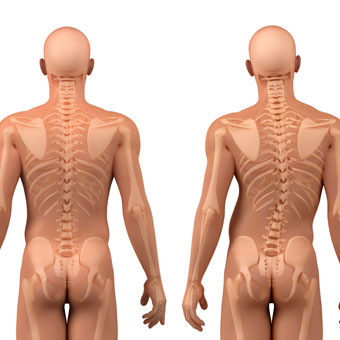 scoliosis posterior crooked and straight
